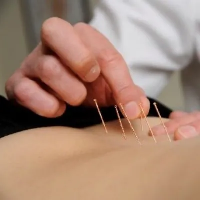 Dry Needling