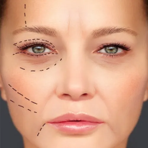 Lip and Facial Dermal Fillers